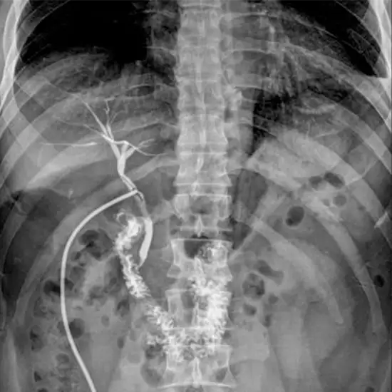 x-ray t tube cholangiogram